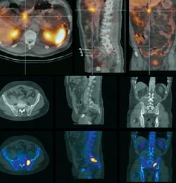 nuclear medicine scans