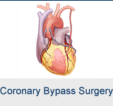 Coronary Bypass Surgery