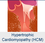 Hypertrophic Cardiomyopathy Program (HCM)