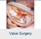Valve Surgery
