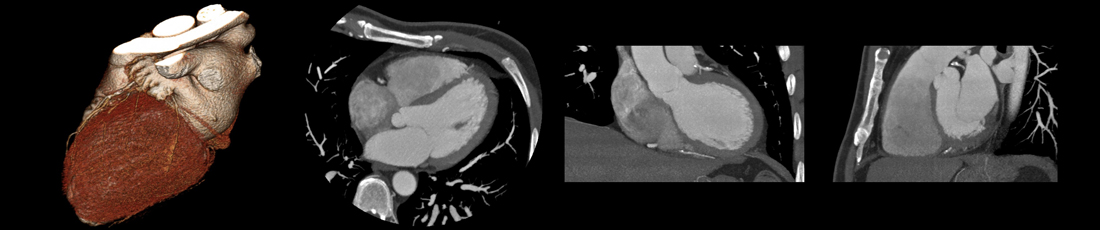 Computed Tomography (CT Scan)