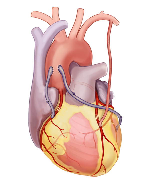 grafting on arteries